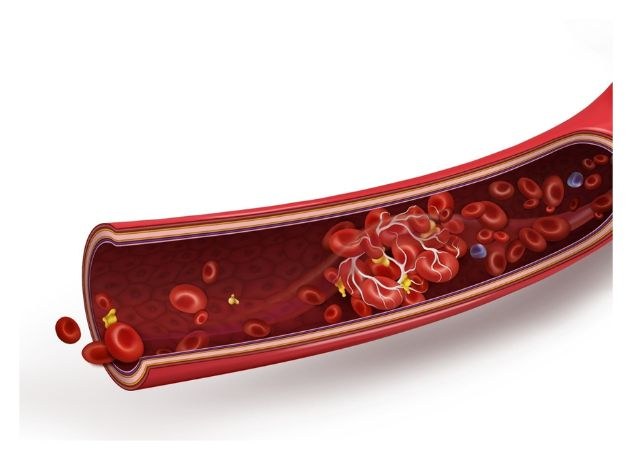 LongCovid - Endotheliitis - Mikrothromben - Mangeldurchblutung