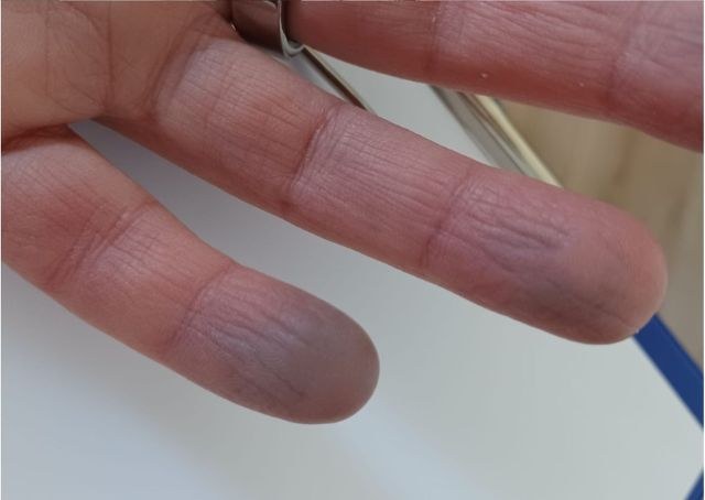 LongCovid - Endotheliitis - Durchblutungsstörungen