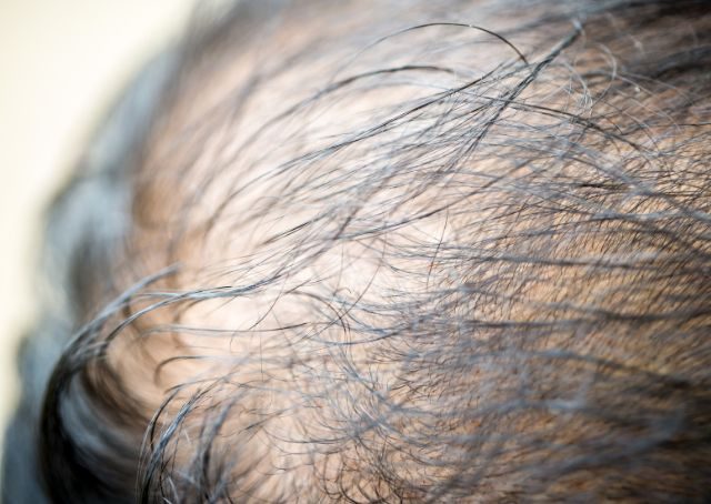 Alopecia areata