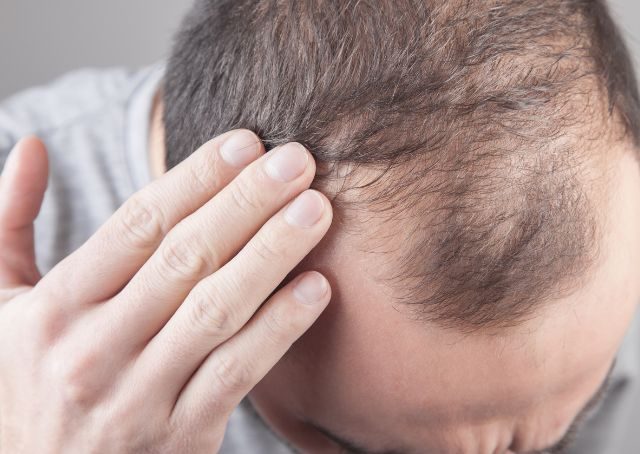 Hormonell bedingter Haarausfall